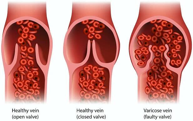 varicose veins are symptoms of a disease
