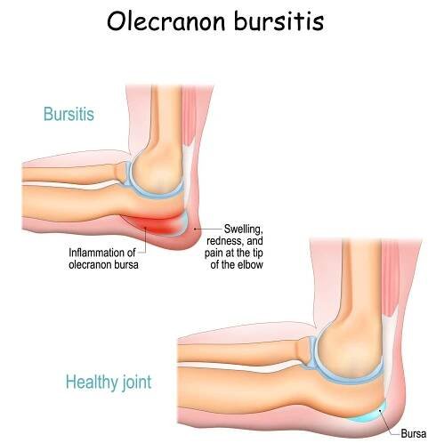 Olecranon Bursitis