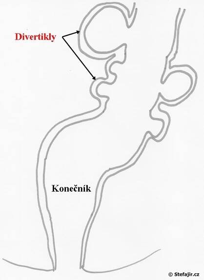 Divertikulóza | Medicína, nemoci, studium na 1. LF UK