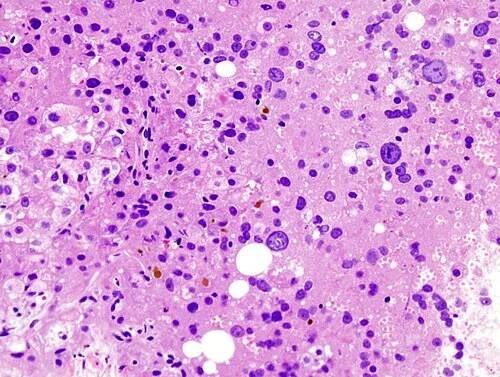 Mikroskopický obraz hepatocelulárního karcinomu