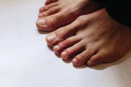 COVIDNÍ prsty na nohou, bolestivé červené a fialové hrbolky, které se objevují na špičkách prstů 