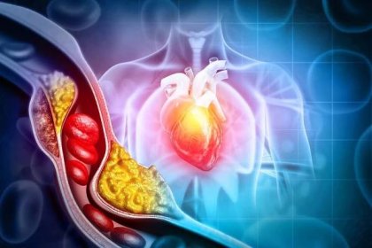 Potraviny, které rozpouští cholesterol v tepnách, pomáhají krvi proudit a slouží jako prevence infarktu