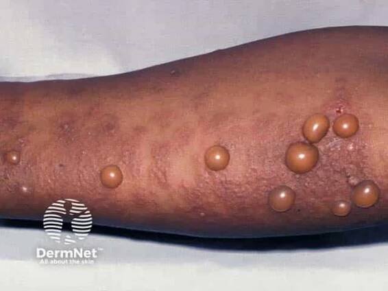 Pemphigoid gestationis
