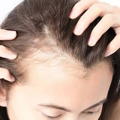 hairloss