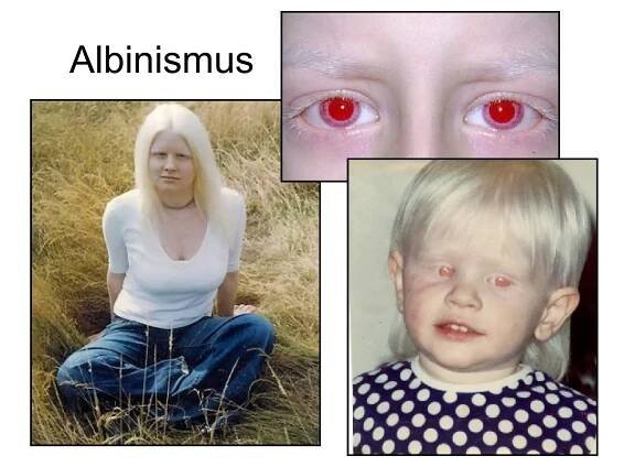 Albinismus 