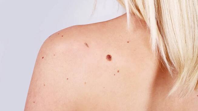 Laserové odstranění výrůstků, bradavic a fibromů
