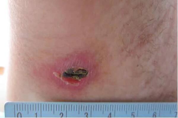 Scrub typhus on the skin with a ruler checking the size