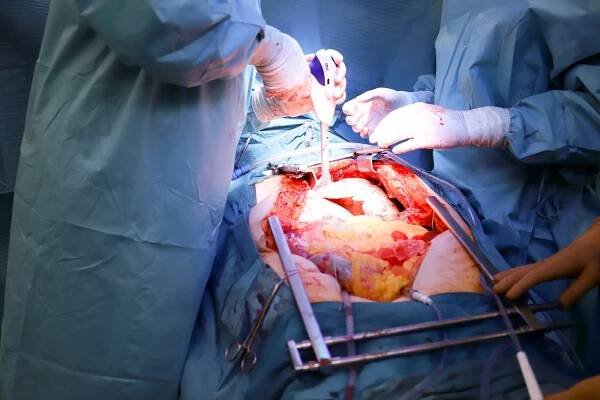 Pacienti po transplantaci plic se díky nové metodě zotaví rychleji a lépe