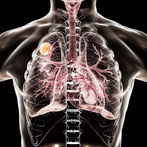 What Exactly Does It Mean to Be Immunocompromised?