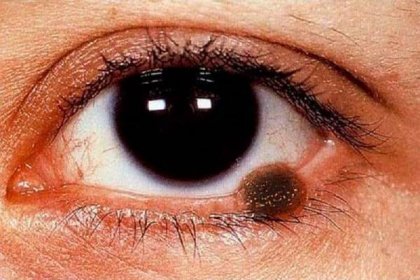 Zhoubné nádory očních víček: příčiny, příznaky, diagnostika, léčba
