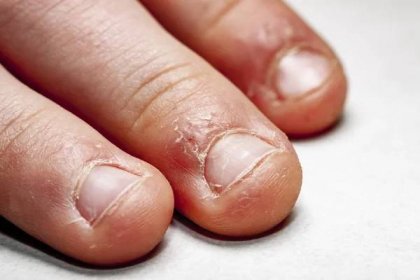 Zavřít z ruky s pokousaný prst a nehty — Stock obrázek