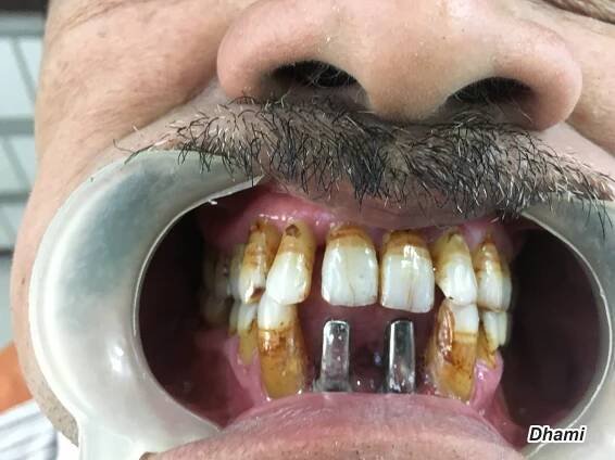 Dental implants | Dhami Dental Clinic | Surat
