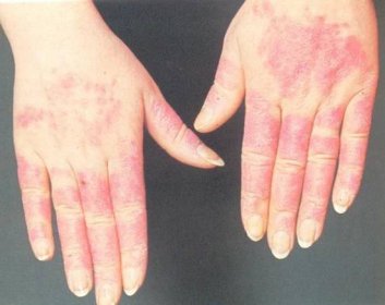 alergie na chlad na rukou příznaky a léčba 