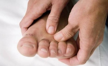 Jak lze vyléčit plísně nehtů, pokud se nacházejí na nohou?