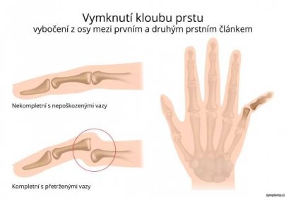 Vymknutí kloubu prstu ruky - příznaky a léčba