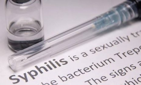Jaké jsou příznaky syfilis | Přečtěte si článek na Unilabs Online