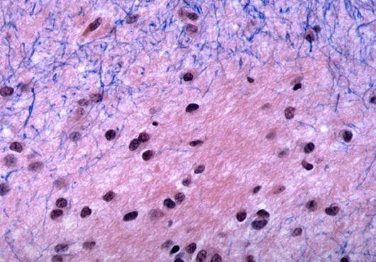 New Understanding of How Genetic Mutation Causes Huntington’s Disease