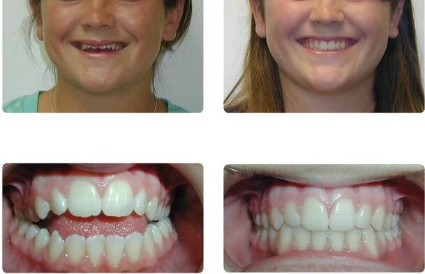 Open Bite: How to Fix an Open Bite Naturally in Adults (Before & After)