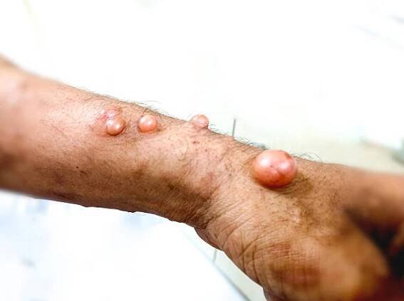 neurofibromatóza je stav, při kterém nádory rostou, příznaky zahrnují světle hnědé skvrny na lidské kůži. - neurofibromatóza - stock snímky, obrázky a fotky