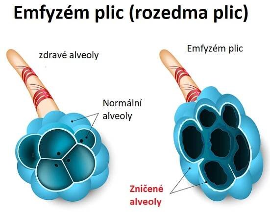 Emfyzém plic - ilustrace
