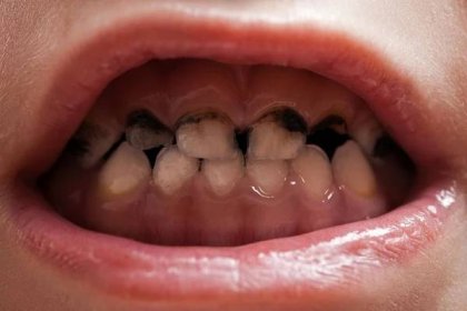 Rozpad zubů zubního kazu — Stock obrázek