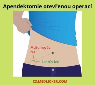 Apendektomie z laparotomie se provádí střídavým řezem, kterým se otevře dutina břišní v pravém podbřišku