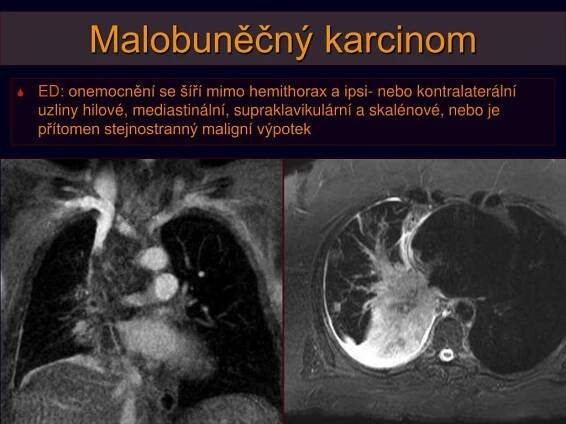 PPT - Nádory plic, pleury a mediastina: BRONCHOGENNÍ KARCINOM PowerPoint Presentation - ID:5892677
