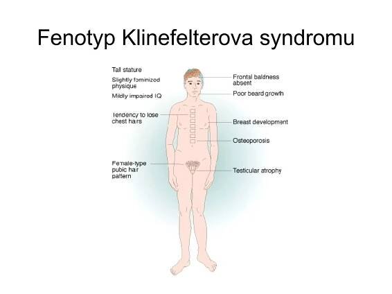 Fenotyp Klinefelterova syndromu 