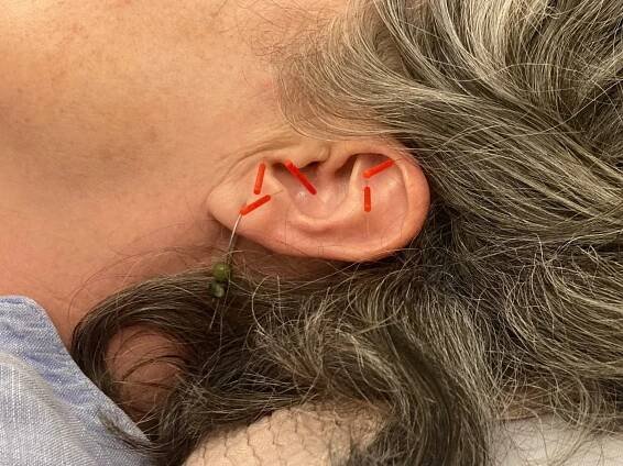 Stress, Anxiety and Trauma - Acupuncture for Mental Health Support