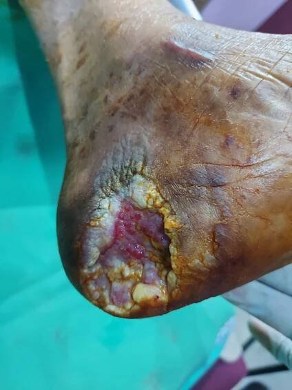 Mrs Raji Ramanathan - Diabetic foot Dry gangrene Amputated - Welcome to Dr. Amina's Royal Ayurveda™