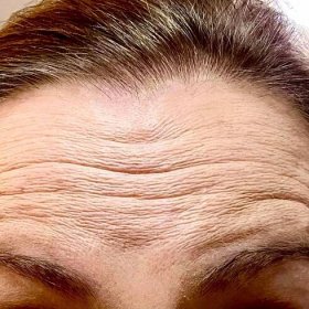 Forehead lines before