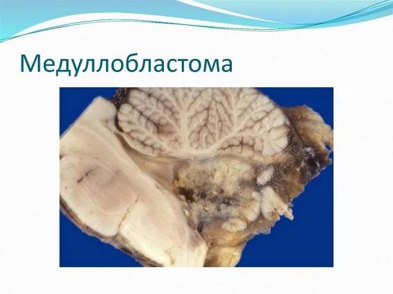 Медуллобластома