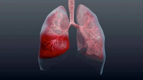 Zápal plic patří mezi zákeřná onemocnění. Včasné rozpoznání příznaků pomůže k rychlejšímu zotavení