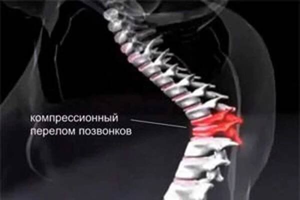 Zlomenina při osteoporóze - co dělat? / Osteoporóza | Užitečné informace a tipy na péči o sebe. Zdraví, výživa a další.