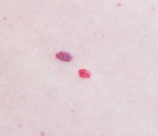 Dvě červené krtky na kůži pacienta, hemangiom, makro, angioneuromy — Stock fotografie