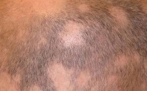 alopeci-haravfall-bild-alopecia-areata_1.jpg
