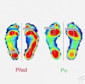 Diagnostika chůze a postavení nohou
