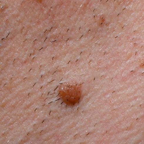 detailní záběr malého, vyvýšeného a chlupatého névu na lidské kůži. - hairy nevus - stock snímky, obrázky a fotky