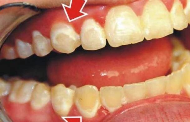 JAK ODSTRANIT VEŠKERÝ zubní kámen SAMI: Udělejte si tuto směs a výsledkem budete nadšeni! (RECEPT)