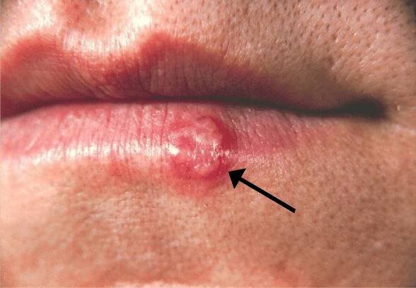 Soubor:Herpes(PHIL 1573 lores).jpg