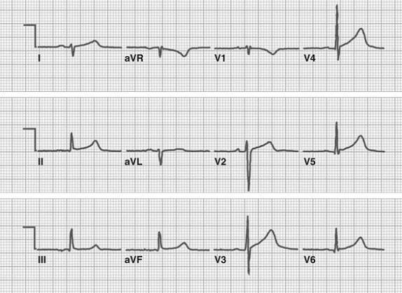 ECG left posterior fascicular block, right axis deviation, deep S waves (I, aVL), tall R waves (III, II, aVF)