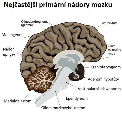 Kraniofaryngeom – nádor v oblasti hypofýzy a hypothalamu – příznaky, příčiny a léčba