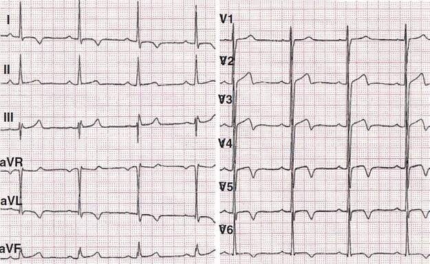 ECG ischemia, unstable angina pectoris, inversion T wave (I, aVL, V2-V6)