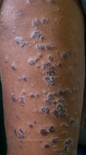 Lower Limb — Black & brown skin