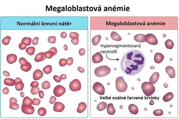 Megaloblastová anémie – porucha tvorby červených krvinek v kostní dřeni – příznaky, příčiny a léčba