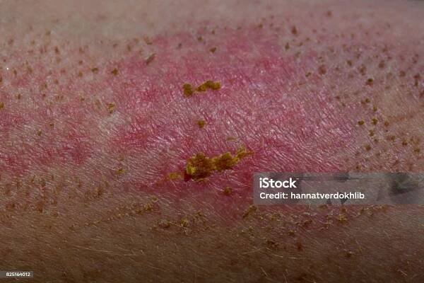 Kožní onemocnění nebo onemocnění zblízka. Rána na kůži se hojí, krusty. Lidské tělo s dermatitidou. Atopická dermatitida, alergická na chemikálie, Svědění nemocných kožních lézí z alergií. Pracovní úraz dermatologa - Bez autorských poplatků Atopická dermatitis Stock fotka