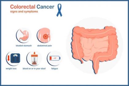 příznaky kolorektálního karcinomu - divertikulitida stock ilustrace