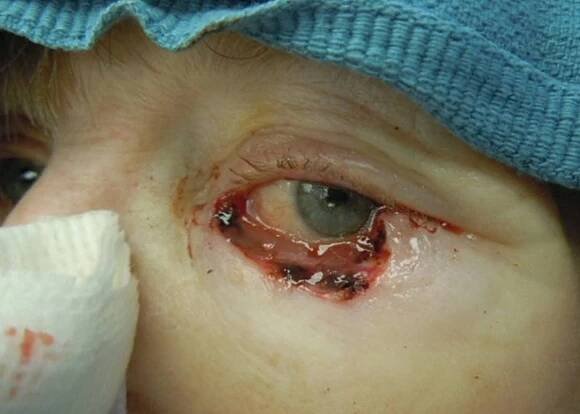 Before skin cancer reconstruction surgery