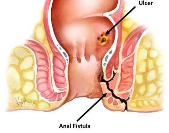 fistula