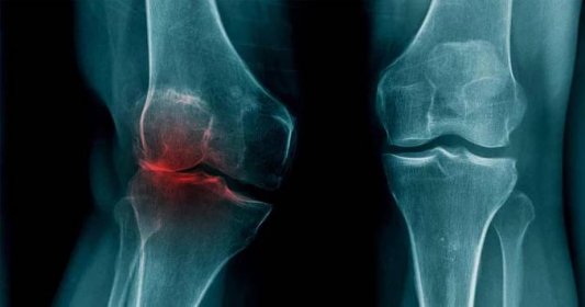 Artroza șchiopă a articulațiilor șoldului ,dureri de spate lăsate în spate